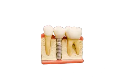 Implantes image Implantes image