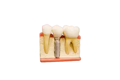 Implantes Implantes