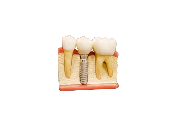 Implantes image Implantes image