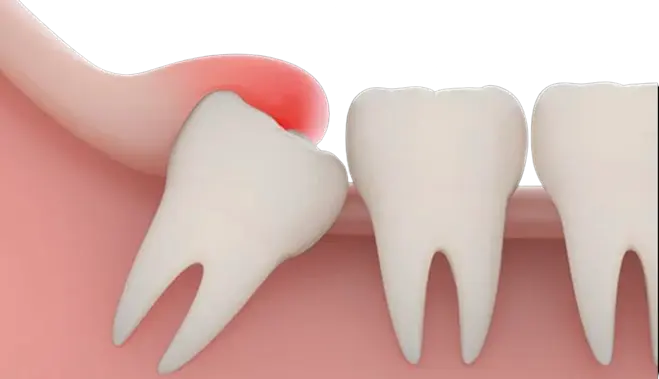Wisdom tooth image Wisdom tooth image